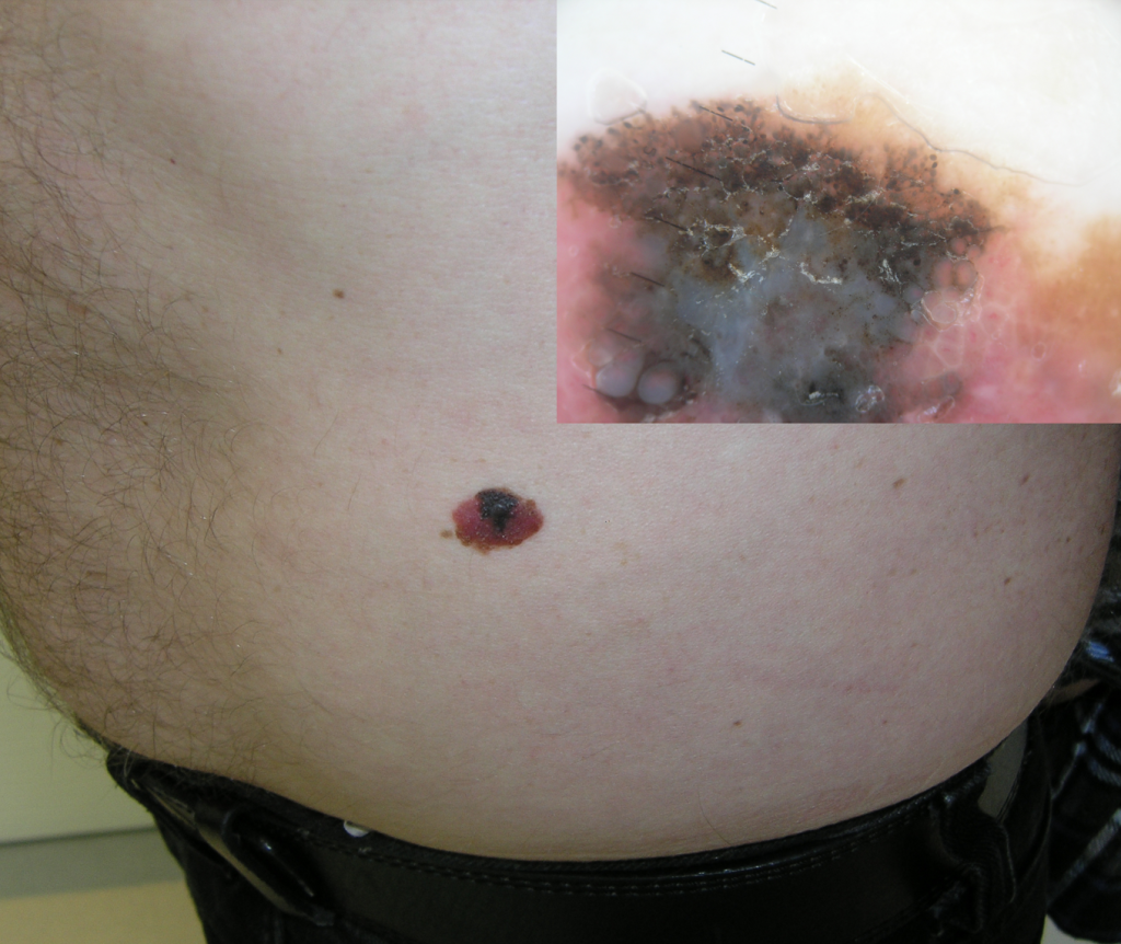 Diagnosticul precoce al cancerelor de piele la Bright Skin