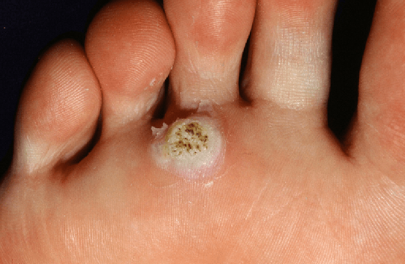 tratamentul micozei degetelor de la picioare seamănă cu condiloamele dar nu cu ele
