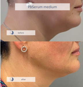 Lipoliză localizată cu PbSerum la Brightskin Cluj-Napoca