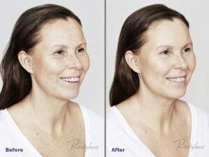 skinboosterele cu acid hialuronic