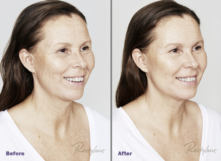 skinbooster cu acid hialuronic