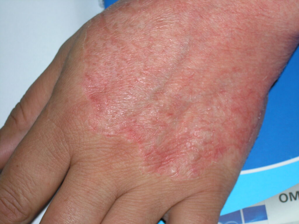 Tinea corporis