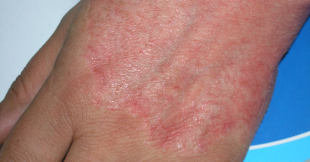 brightskin 2
