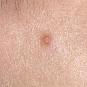 Molluscum contagiosum