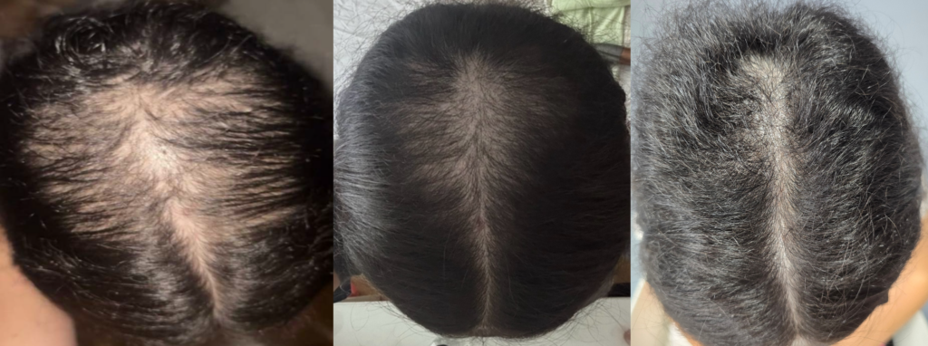 Alopecia areata