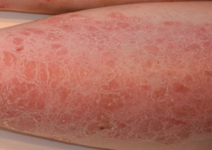 Leziuni Psoriazis