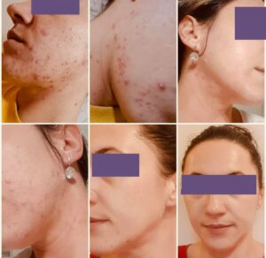 Tratăm cu succes acneea la Brightskin dermatologie