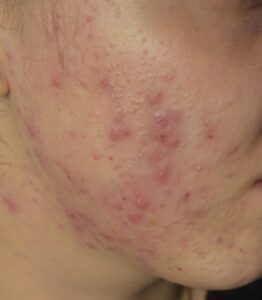 Terapia acneei vulgare la BrightSkin Cluj-Napoca și Florești