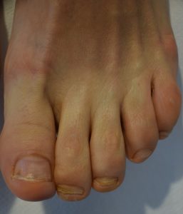 Tratăm onicomicoza (ciuperca unghiei) la Bright Skin Cluj-Napoca