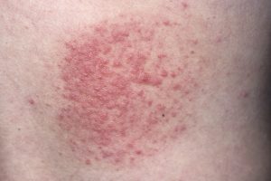 Alergia la soare - BrightSkin cabinet dermatologie
