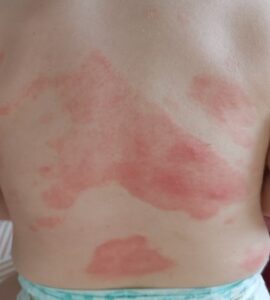 Cabinet Cluj 3 Dermatita atopică